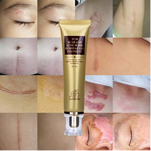 Acne Scar Removal Cream - jetlove