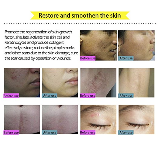 Acne Scar Removal Cream - jetlove